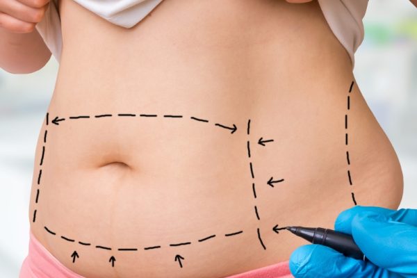 tummy-tuck-photo-sq_219739310